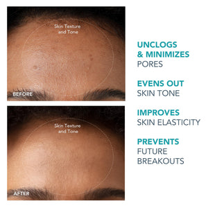 Diamond Microdermabrasion & Pore Vacuum Facial Device